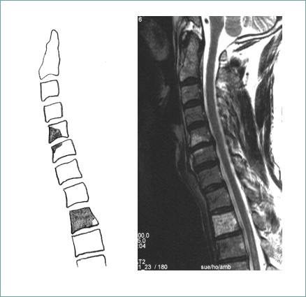 Bandscheibenvorfall HWS - Symptome, Diagnostik Und Therapie